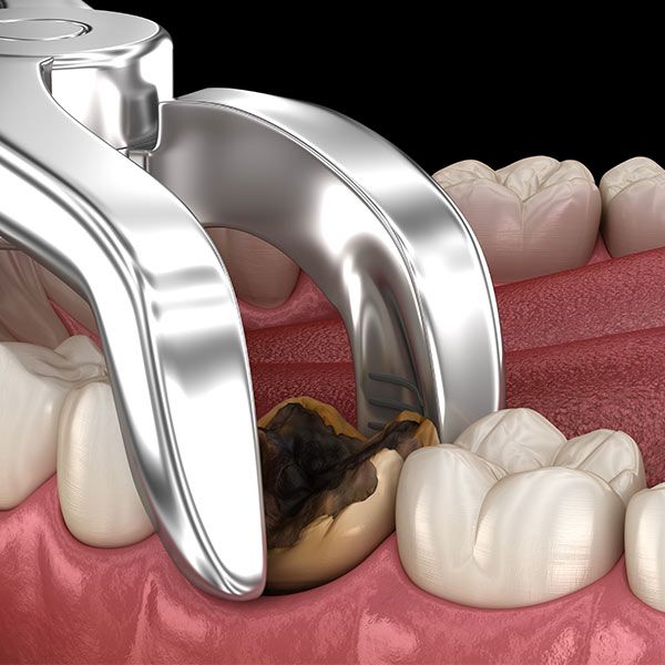 tooth extraction