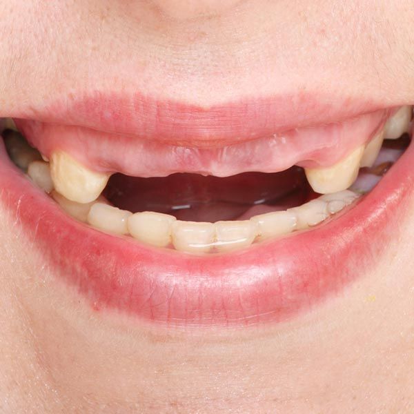 Patient missing front teeth